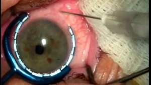 Инъекция в глаз (Eye injection)