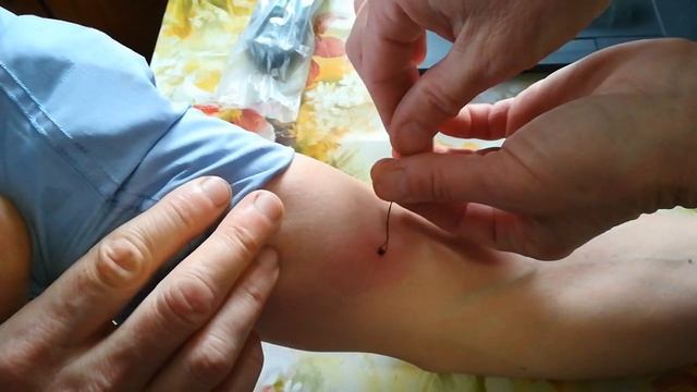 Лёгкий способ вытаскивания клеща смотреть онлайн