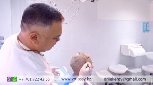 Пересадка волос методом FUE