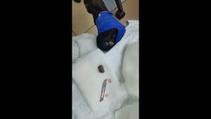 Удаление опухоли кожи под местной анестезией. Хирург -Баннов Павел Викторович..mp4