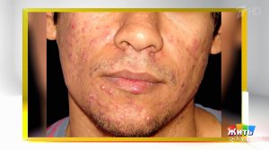 Кто занимается сексом на вашем лице? Жить здорово! Фрагмент выпуска от 18.06.2020