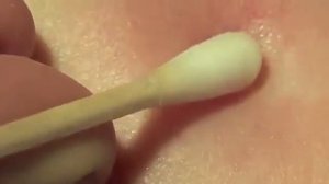 Как удалить клеща с помощью ватной палочки