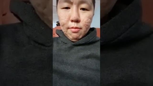 Лечим прыщ , Акне ! Роаккутан ! Диета!Лазерный пиллинг!Бодяга дёшево сердито против шрамов от Акне! смотреть онлайн