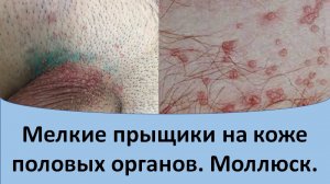 Мелкие прыщики на половых органах. Моллюск
