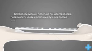 Фиксация сложного (оскольчатого) перелома диафизарного сегмента бедренной кости