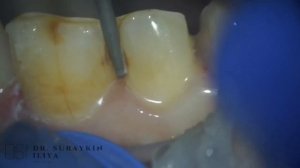 Teeth prep for emax , dental , dentist , dentistry , препарирований зуба под коронку , имплантация