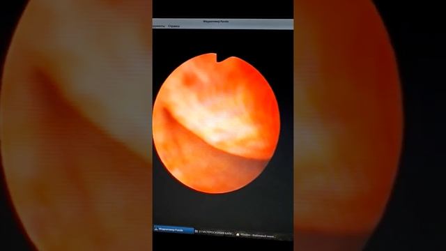 Субмукозная миома тела матки. смотреть онлайн