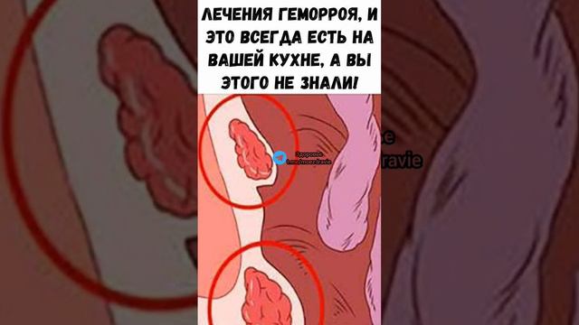 лечение геморроя #полезныесоветы #здоровье #медицина #полезно #здоров #зож