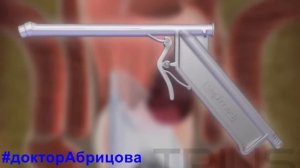 Лигирование латексными кольцами. Лечение геморроя