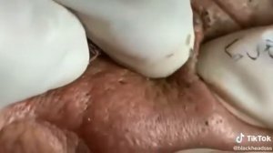 Выдавливает прыщи у деда на носу