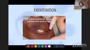 Mucor Decoded - Ophthalmologist Perspective