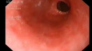 Пищевод Барретта