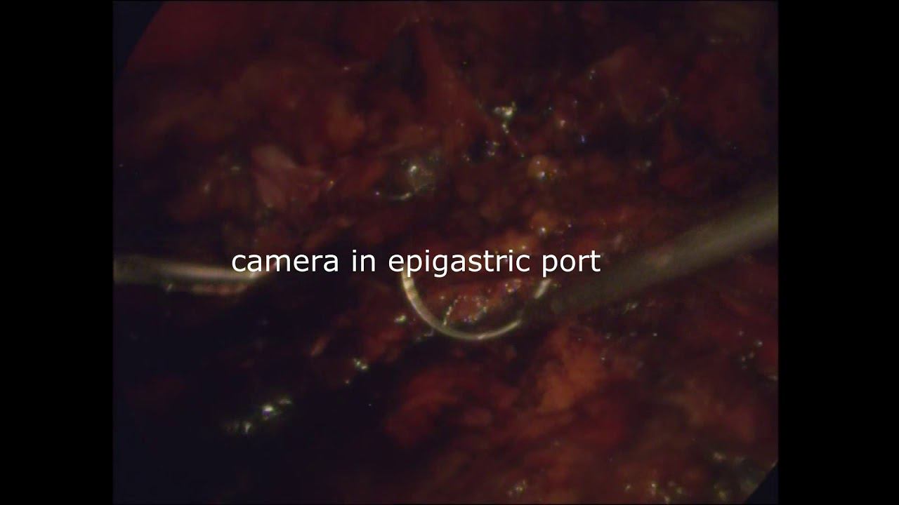 laparoscopic eTeP TAR for ventral hernia M234W3R0 смотреть онлайн