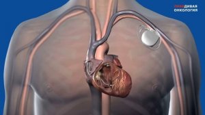 Острая сердечная недостаточность