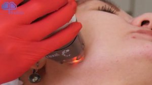 Процедура лазерного омоложения ФРАКСЕЛЬ (Fraxel)