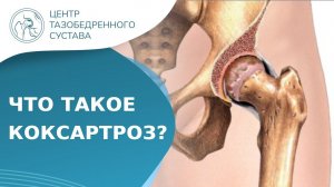Что такое коксартроз (артроз тазобедренного сустава)? Что такое коксартроз. 18+