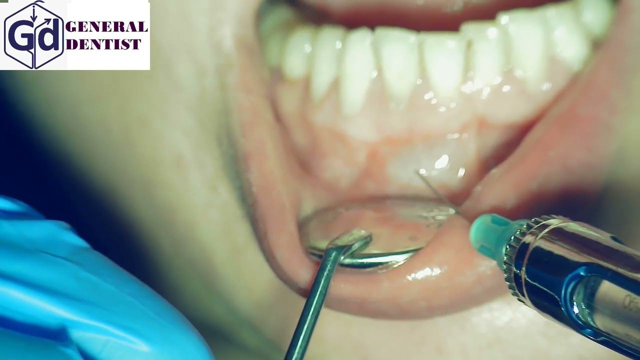 Infiltration anesthesia for treatment  tooth 42.