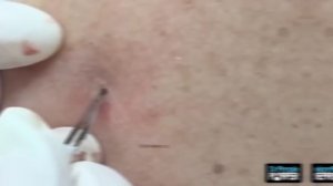 Dr. Pimple Poppers 8 WORST Blackhead Removals - You're not going to want to eat while you watch thi