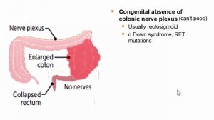 USMLE RX - 4.Желудочно-кишечный тракт - 3.Патология - 20.Болезнь Гиршпрунга