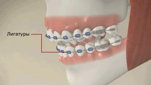 Брекеты: установка брекетов, исправление прикуса