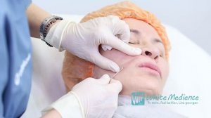 White Medience - заполнение глубоких морщин носогубных складок с помощью мезонитей
