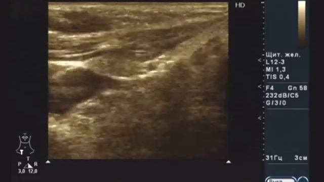 Видеозапись УЗИ - Добавочная долька ромбовидная области нижнего полюса правой доли щитовидной желез