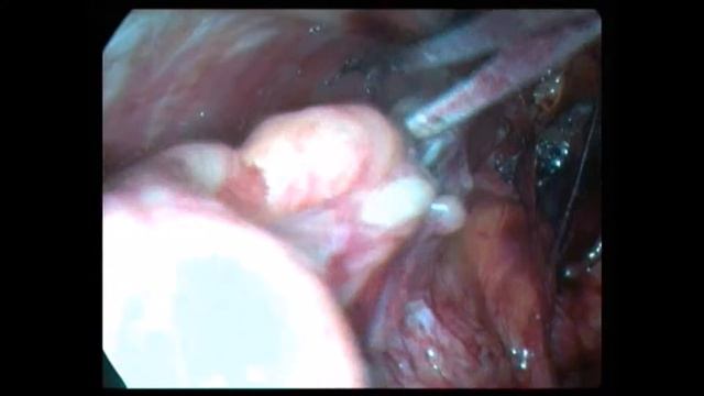 Герниопластика ТАРР. смотреть онлайн