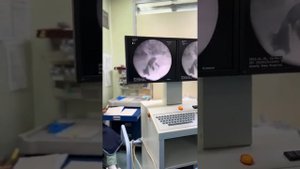 Как  удаляют  камни  из почек  SUB  ENG