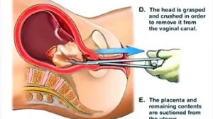 Illustrated abortion procedure!! What REALLY happens at the abortion clinic!!!