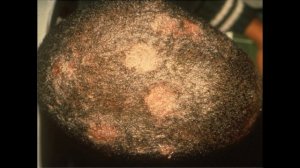 Микроспория. Трихофития. Микроспория у человека. Трихофития у человека.