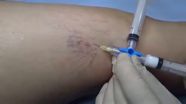 Склеротерапия, случай из практики