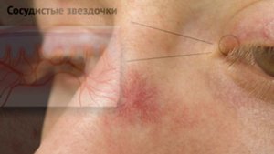 Сосудистые «ЗВЕЗДОЧКИ»❌ КАК ИХ УБРАТЬ?✅ 4 простых способа ИЗБАВИТЬСЯ от КУПЕРОЗА!