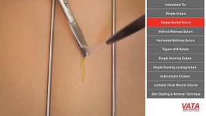 Техника наложения простого  погруженного шва