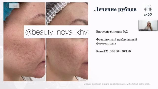 Фототерапия, неаблятивный фракционный фототермолиз и их сочетанное применение