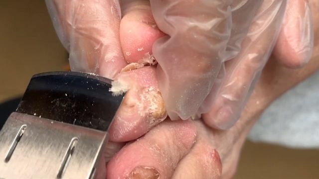 calluses on the front of the toes【Xiao Yan Pedicure】 смотреть онлайн