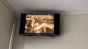 Второй скрининг подробно, четко и по делу.