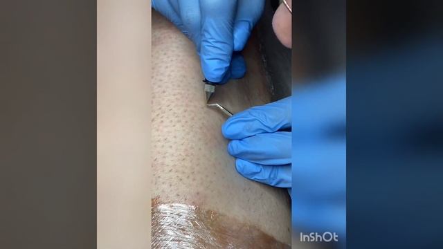 электроэпиляция. вжух! волшебство)! смотреть онлайн