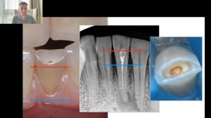 Уроки эндодонтии. Почему темнеют депульпированные зубы