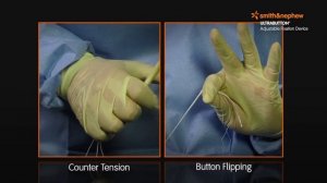 ULTRABUTTON* Device and BIOSURE* REGENESORB Screw for ACL Reconstruction with a Hamstring Graft