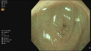 Optical diagnosis: tubular adenoma with HGD?