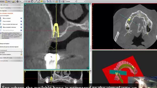Implant and sinus lift planning смотреть онлайн