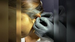 Highlights - Tragus and Helix piercing with catheter and needle.