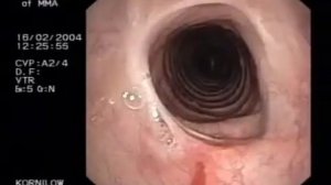 Стеноз трахеи (РНЦХ РАМН)