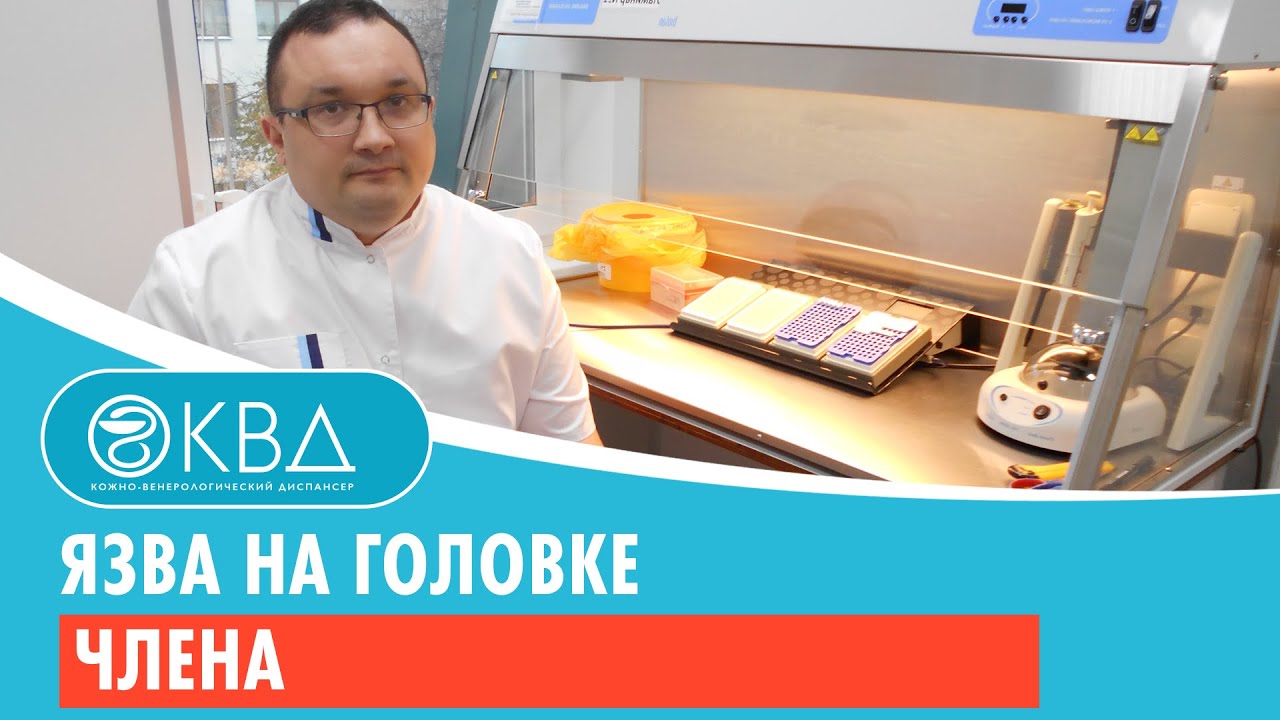 Язва на головке члена. Клинический случай №143