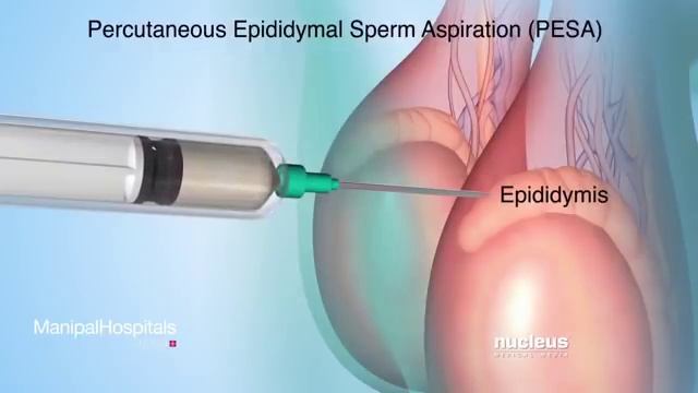 Sperm Retrieval Techniques смотреть онлайн