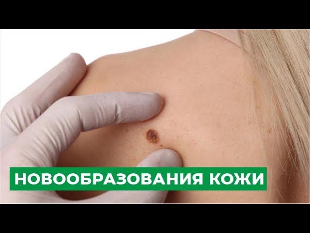 Новообразования кожи
