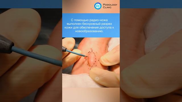 Удаление кисты на стопе #подология #хирург #хирургия #удалениеновообразований #дерматология