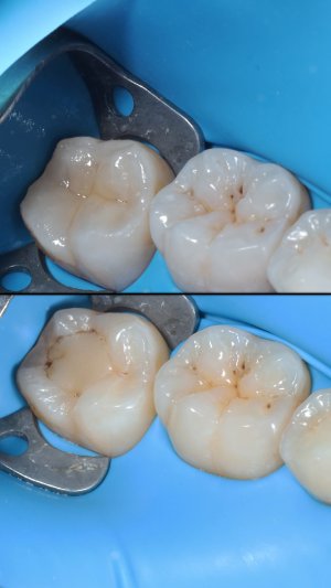Эстетическая реставрация зубов в ADN Clinic