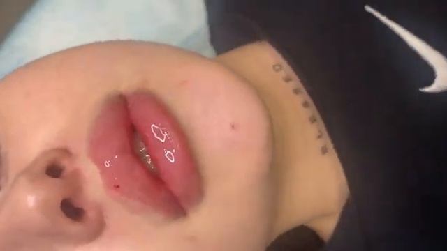 Збільшення губ.Київ смотреть онлайн