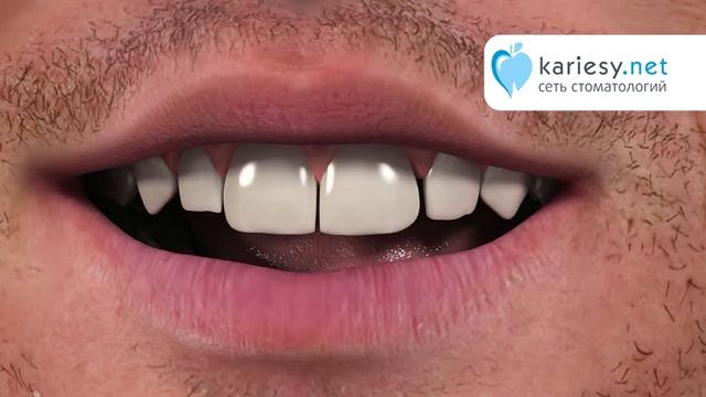 Металлокерамическая коронка смотреть онлайн